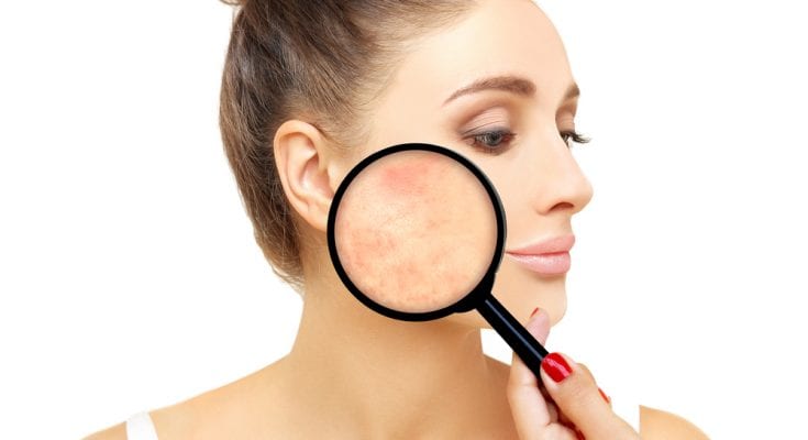 rosacea