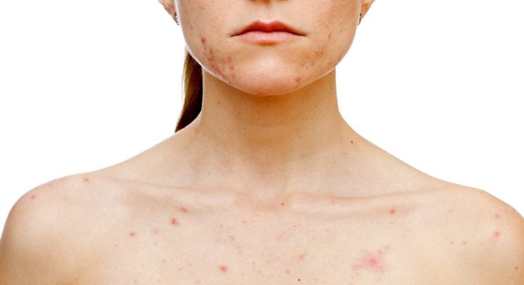 chest acne