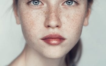 pale freckles