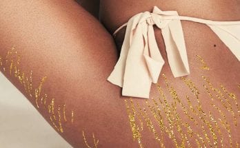 Stretch Marks. Home Remedies For Treating Them