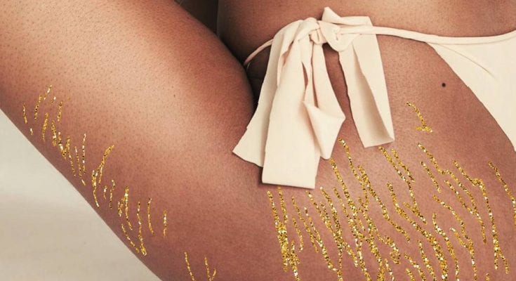Stretch Marks. Home Remedies For Treating Them