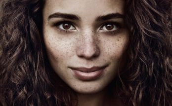 Say Goodbye to Freckles: Six Natural Remedies